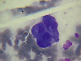 Illustration for article titled Cancer is just as deadly as it was 50 years ago. Here's why that's about to change.